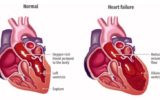 Congestive Heart Failure